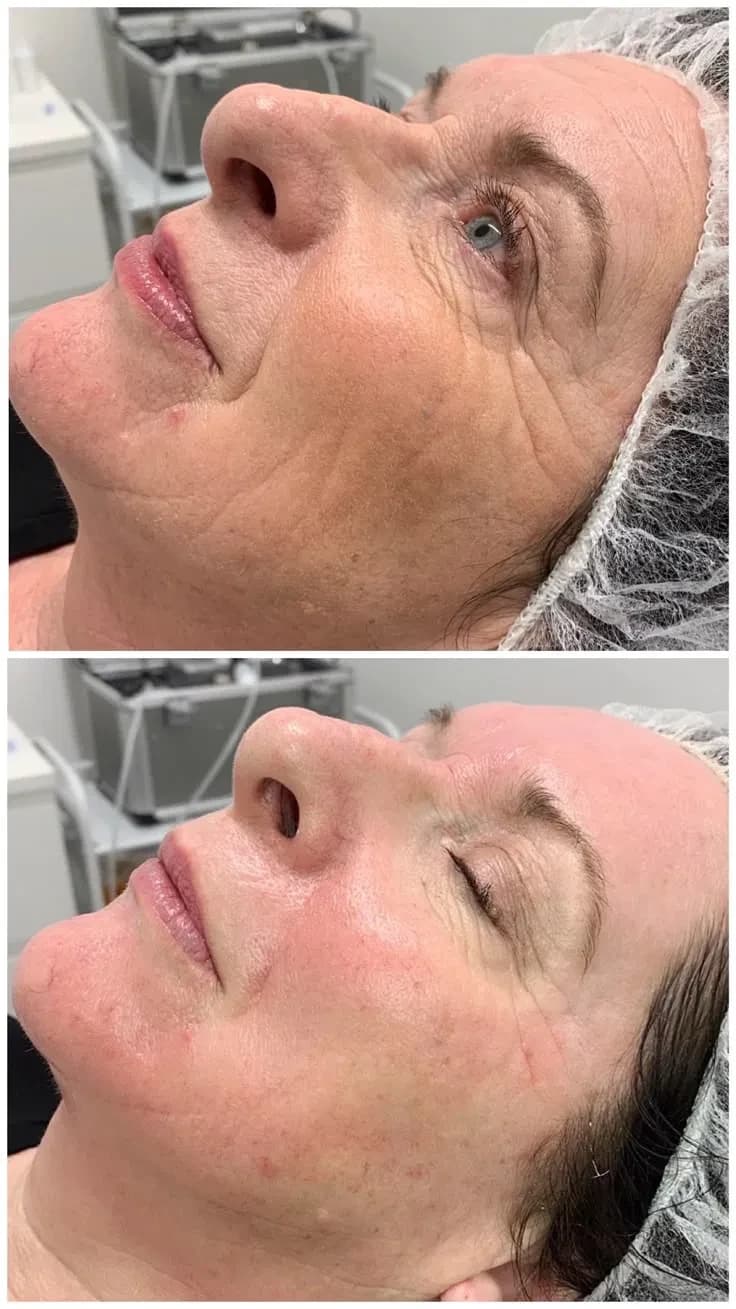 Botox treatment at Image Clinic