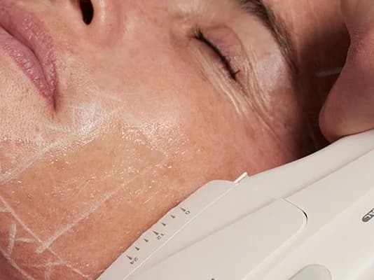 HIFU treatment at Image Clinic